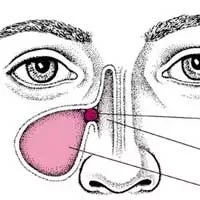 急慢性副鼻窦炎的表现