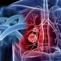肺放线菌病的发病原因是什么？肺放线菌病需要做什么检查？