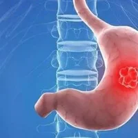 什么是胆汁返流性胃炎？胆汁返流性胃炎有哪些症状？