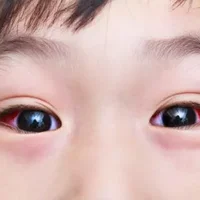 眼睑肿胀是红眼病的症状 预防红眼病多吃解毒食物