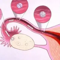 哪些人容易子宫内膜增生？子宫内膜增生做哪些检查？