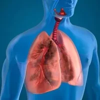 肺囊肿该怎么治疗？肺囊肿会传染吗