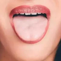 什么是胖大舌？哪些疾病会引起胖大舌？