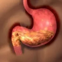 什么是胃粘膜脱垂症？为什么会患胃粘膜脱垂症？