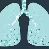 肺纤维化是怎么回事？肺纤维化的早期症状