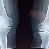 膝关节肿胀怎么办,膝关节肿胀的鉴别诊断