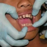 慢性牙周炎是什么,慢性牙周炎不能磨牙吗
