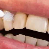 氟斑牙牙齿美白的方法,氟斑牙的预防