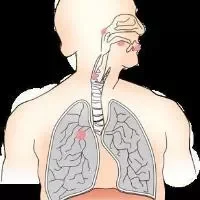 肺结核肝囊肿会胸腔积水吗,肺结核肝囊肿胸腔积水怎么办