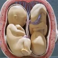 宝宝睾丸鞘膜积液怎么办,什么是睾丸鞘膜积液