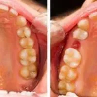 牙髓炎补牙,牙髓炎是什么有哪些症状