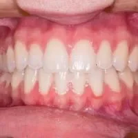 慢性牙龈炎是癌症吗,什么是慢性牙龈炎