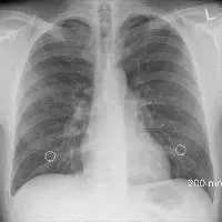 术后肺不张的护理措施有哪些,肺不张的原因有哪些