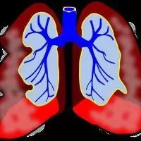 治疗肺气肿喷雾剂,导致肺气肿的原因