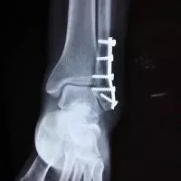 踝关节扭伤一年才好,踝关节扭伤后的注意事项