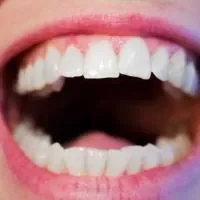 洗牙牙龈出血怎么止血,洗牙牙龈出血的注意事项