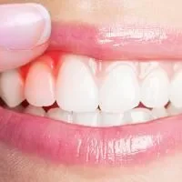 刷牙牙齿出血怎么回事,刷牙牙龈、牙齿出血的具体原因