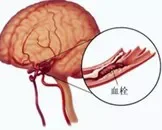 外伤性脑血栓应该怎么治疗