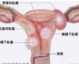 子宫肌瘤与子宫腺肌病应该怎么治疗