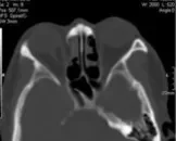 爆裂性眼眶骨折的饮食禁忌_都有哪些症状