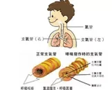 慢性支气管哮喘,慢性支气管哮喘的原因