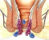 肛门直肠周围脓肿的饮食禁忌_肛门直肠周围脓肿的病因