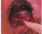 阴道黑色素瘤症状