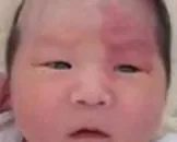 婴儿身上青色胎记的成因_宝宝有青色胎记怎么办