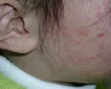皮肤荨麻疹