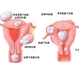 黏膜下子宫肌瘤的保守治疗