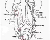 膀胱结石输尿管结石有什么不同