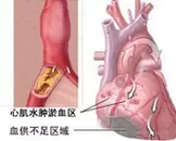 心肌缺血冠脉搭桥术的4种并发症