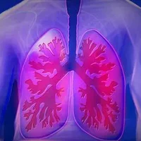 中央性肺癌中晚期症状,三种方法远离中央性肺癌