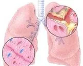 肺大泡和肺大泡的区别