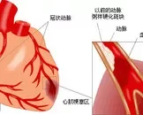 急性心肌梗死的前兆