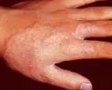 手癣最佳治疗方法有哪些