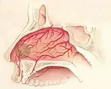 鼻血管瘤