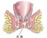 慢性肛裂怎么办呢