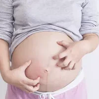 妊娠合并生殖器疱疹的治疗方法