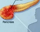 胰腺癌的早期症状体重明显下降是胰腺癌症状吗