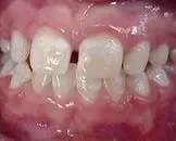 乳牙釉质发育不全有什么症状