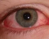 眼睛红不等于是“红眼病”