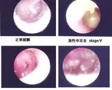 中耳炎可损害大脑