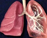 如何治疗呼吸机相关性肺炎