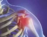穴位注射治疗肩周炎的方法