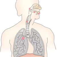 声门上型喉癌分期有什么症状,如何检查声门上型喉癌
