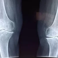 月骨脱位复位手法的步骤有哪些,月骨脱位的疾病概述