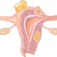腹腔里张纤维瘤,腹壁纤维瘤的治疗方式