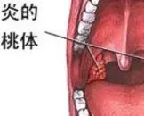 急性扁桃体炎和慢性扁桃体炎的区别