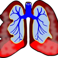 肺神经性内分泌肿瘤是什么,肺神经性内分泌肿瘤有哪些类型